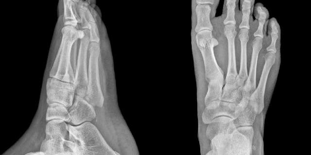 Detailed X-ray image of two feet. In Washington state, the use of X-ray machines for nonmedical foot measuring in shoe sales or otherwise is prohibited.