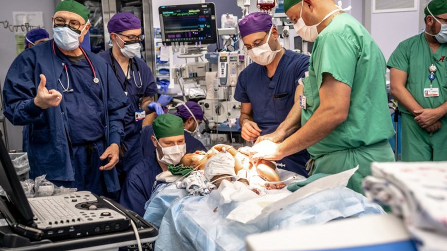 Doctors separating conjoined twins AmieLynn and JamieLynn