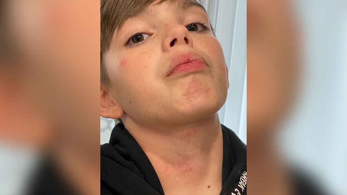 Virginia student's neck is seen after being choked on school bus