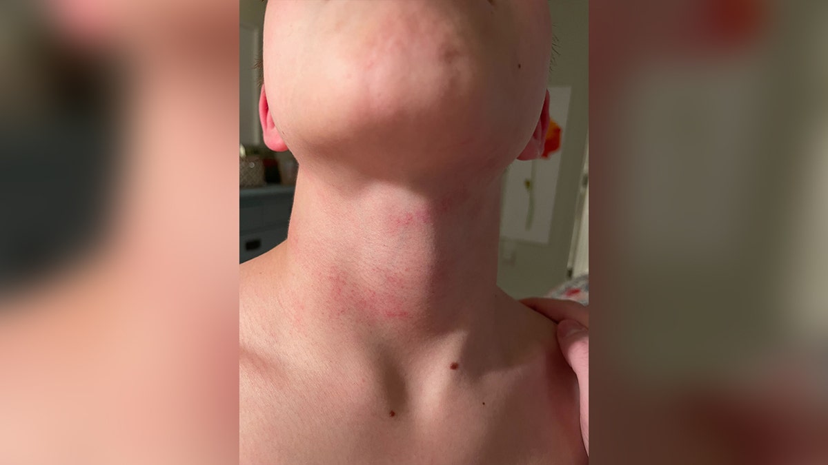 Virginia student's neck is seen after being choked on school bus
