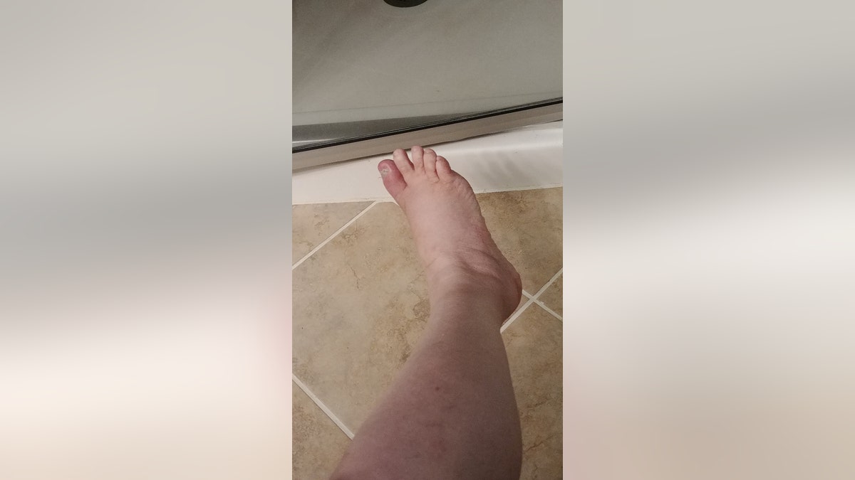 Woman has five toes amputated after catching an infection from a FISH SPA
