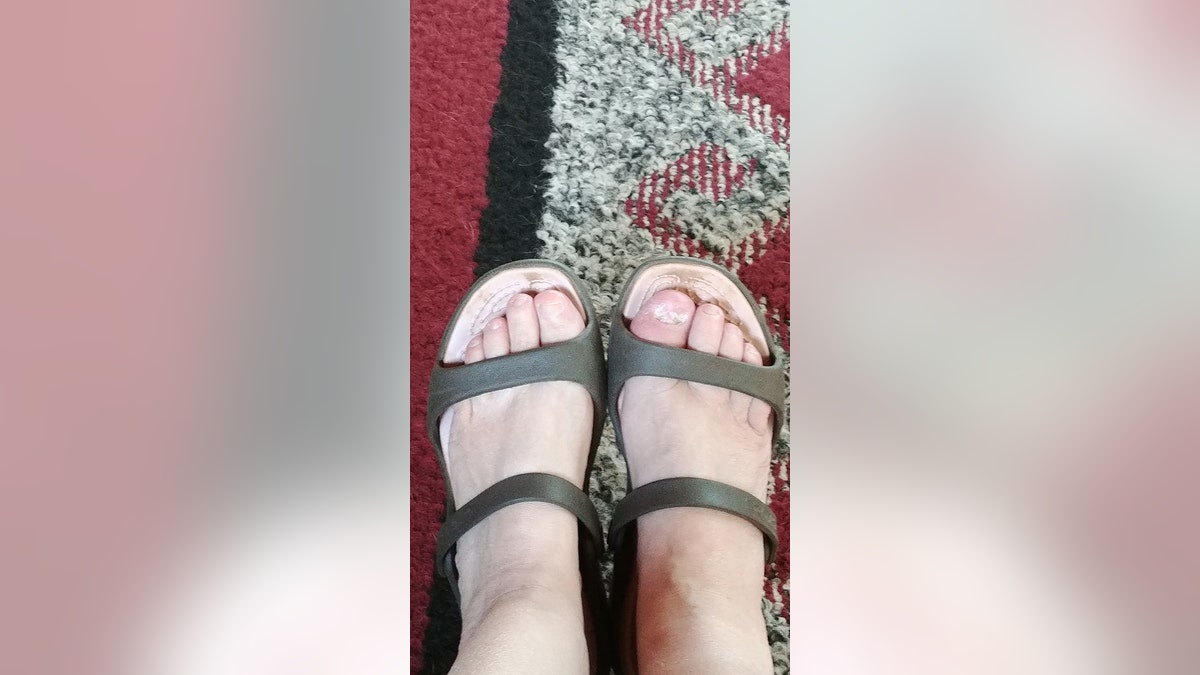 anita house infected toe
