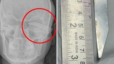 Attacked in head: Man stabbed in skull with knife, almost loses left eye