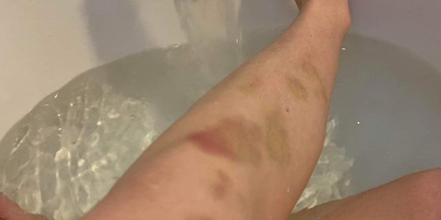 Bruises on Adriana Kuch's legs after she was bullied at the local high school.  