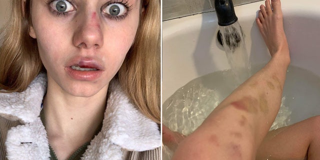 Pictures show injuries Adriana Kuch, a 14-year-old New Jersey high school student, suffered during an attack in school. She took her own life after video was posted online of a group of girls assaulting her.