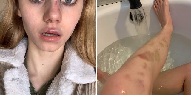 Pictures show injuries Adriana Kuch, a 14-year-old New Jersey high school student, suffered during an attack in school. She took her own life after video was posted online of a group of girls assaulting her.