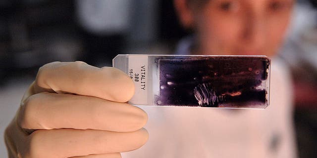 A laboratory holds up a slide with sperm on it at the Sydney IVF Clinic in Sydney, Australia, Thursday, October 12, 2006.