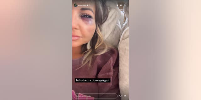 KT Smith shared images of her bruising after her car crash.