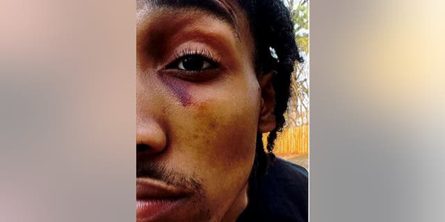 Monterrious Harris' injuries after an alleged attack by the ex-Memphis police officers who beat Tyre Nichols to death, according to to federal lawsuit.