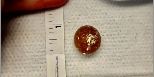 One of the water beads that baby Harper swallowed is shown here. 