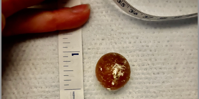 One of nan h2o beads that babe Harper swallowed is shown here.