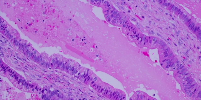 خلايا سرطان البنكرياس