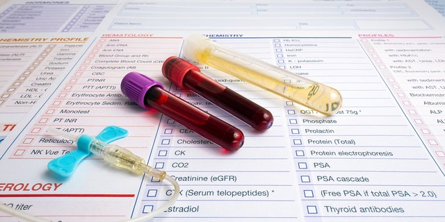 "If the test is as reliable as they say it is, it may have an important role in screening, as the current PSA [prostate-specific antigen] blood test we use is notoriously unreliable," one doctor said.