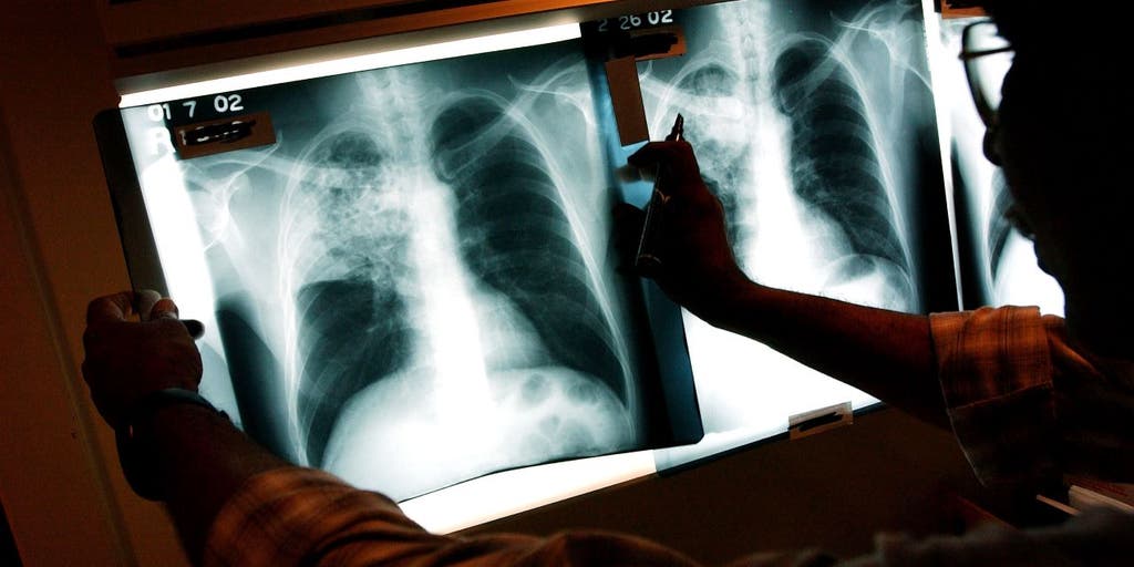 Washington woman with tuberculosis arrested, jailed after refusing to isolate: 'Necessary intervention' - Vimarsana News