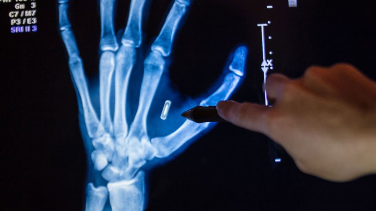 chip implanted into hand X-ray