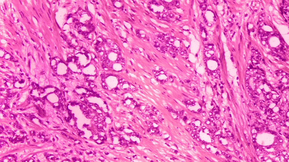 Prostate cancer under a microscope