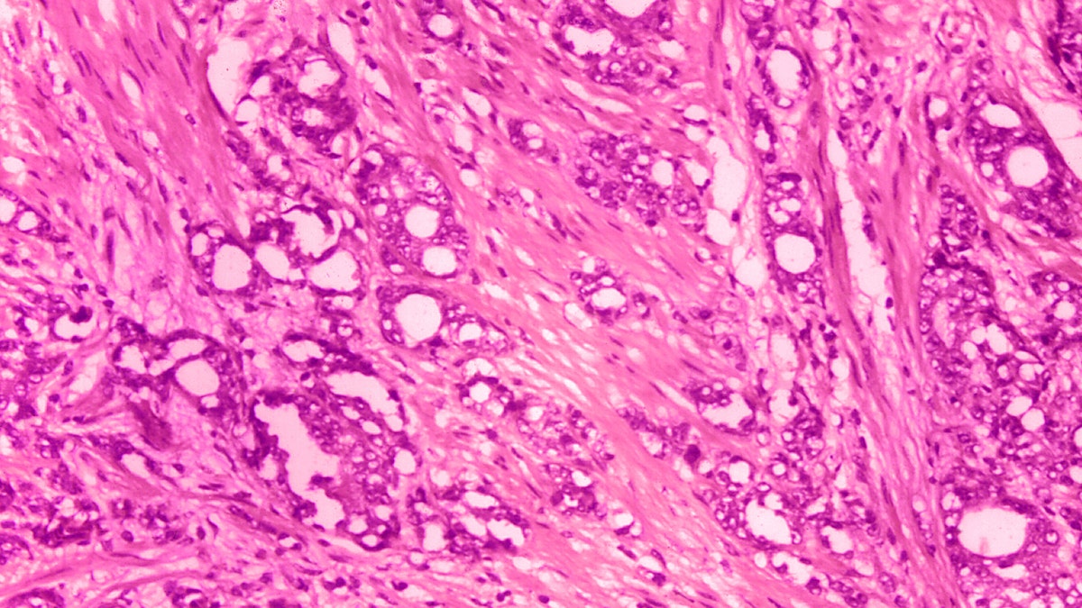 Prostate cancer under a microscope