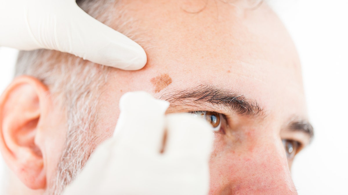 Man with cancer spot