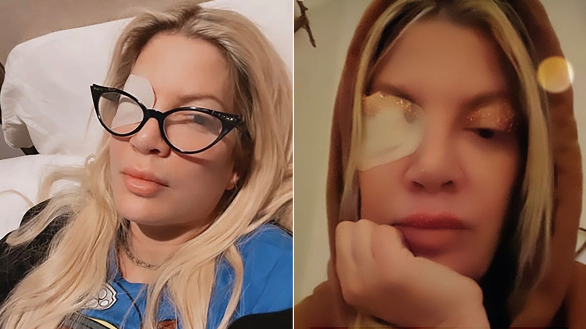 tori spelling wearing eye patch in selfies