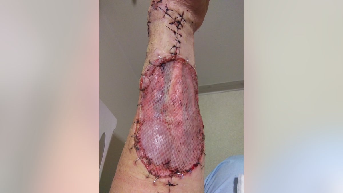 A xylazine wound on a users forearm