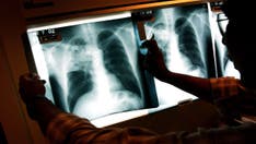 US tuberculosis cases in 2023 were at highest level in a decade, CDC says