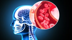 Stanford researchers develop ‘game-changing’ stroke treatment that doubles effectiveness