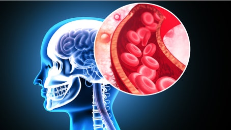 Stanford researchers develop ‘game-changing’ stroke treatment that doubles effectiveness