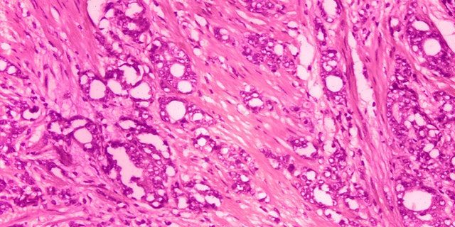 This 1974 microscope image made available by the Centers for Disease Control and Prevention shows changes in cells indicative of adenocarcinoma of the prostate.