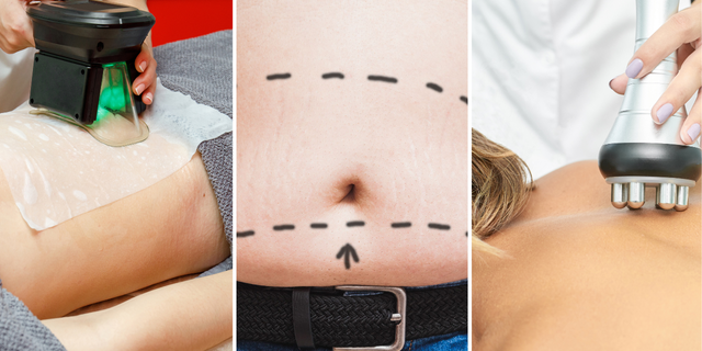 Body contouring options for spot-reducing fat include cryopolis (left), liposuction (middle) and radiofrequency cryopolis (right).
