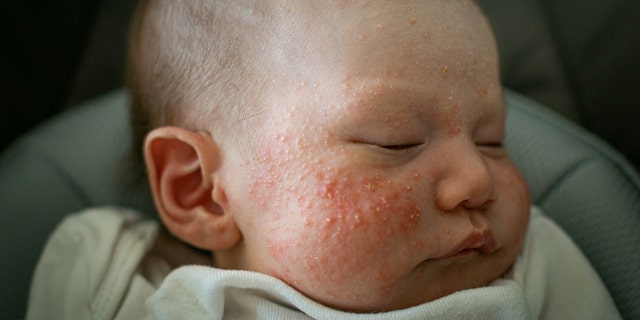 Babies with eczema, a condition marked by dry, itchy skin and rashes, are at a higher risk of developing food allergies.