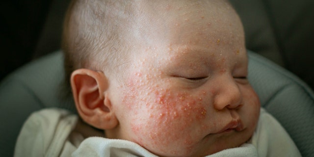 Babies with eczema, a condition marked by dry, itchy skin and rashes, are at a higher risk of developing food allergies.