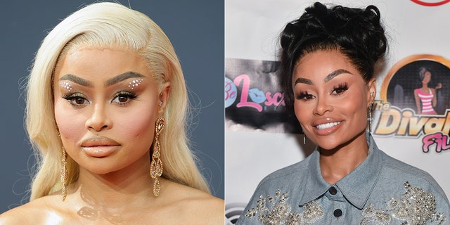 Blac Chyna shared that she removed filler from her face. The picture on the left is before the procedure and on the right is after the first round of dissolvement.