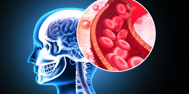 A stroke, or brain attack, occurs when an artery that supplies blood to the brain either gets blocked or ruptures. Aaron Sorkin suffered an acute stroke, he shared recently.