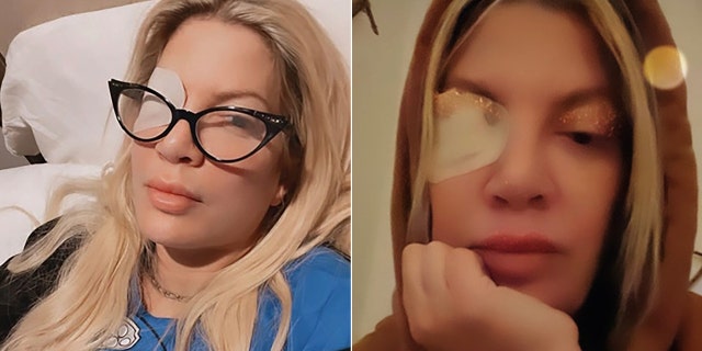 Tori Spelling revealed she had an ulcer on her eye with a post on social media.