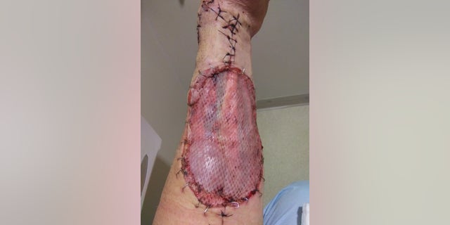 A drug user shows off a wound caused by xylazine, also known as tranq or the zombie drug.
