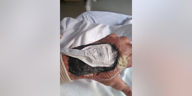Xylazin-Wunde an der Hand eines Drogenkonsumenten
