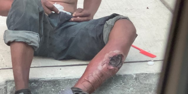 A drug user sits on a Philadelphia sidewalk with an exposed wound from xylazine — a common sight in the Kensington neighborhood.