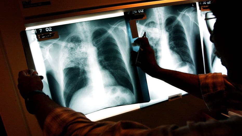 California Tuberculosis outbreak kills 1, infects 14 as officials declare health emergency