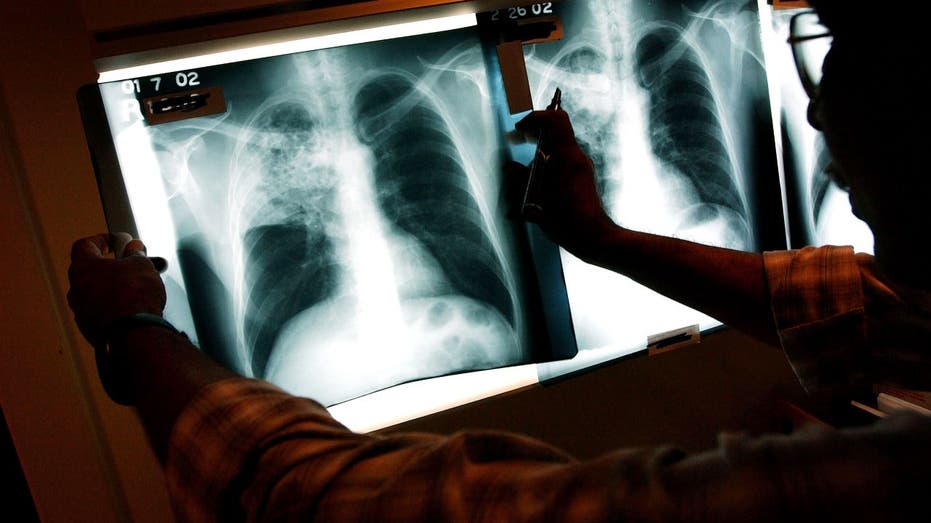 U.S. tuberculosis cases will reach their highest level in a decade in 2023, according to the CDC