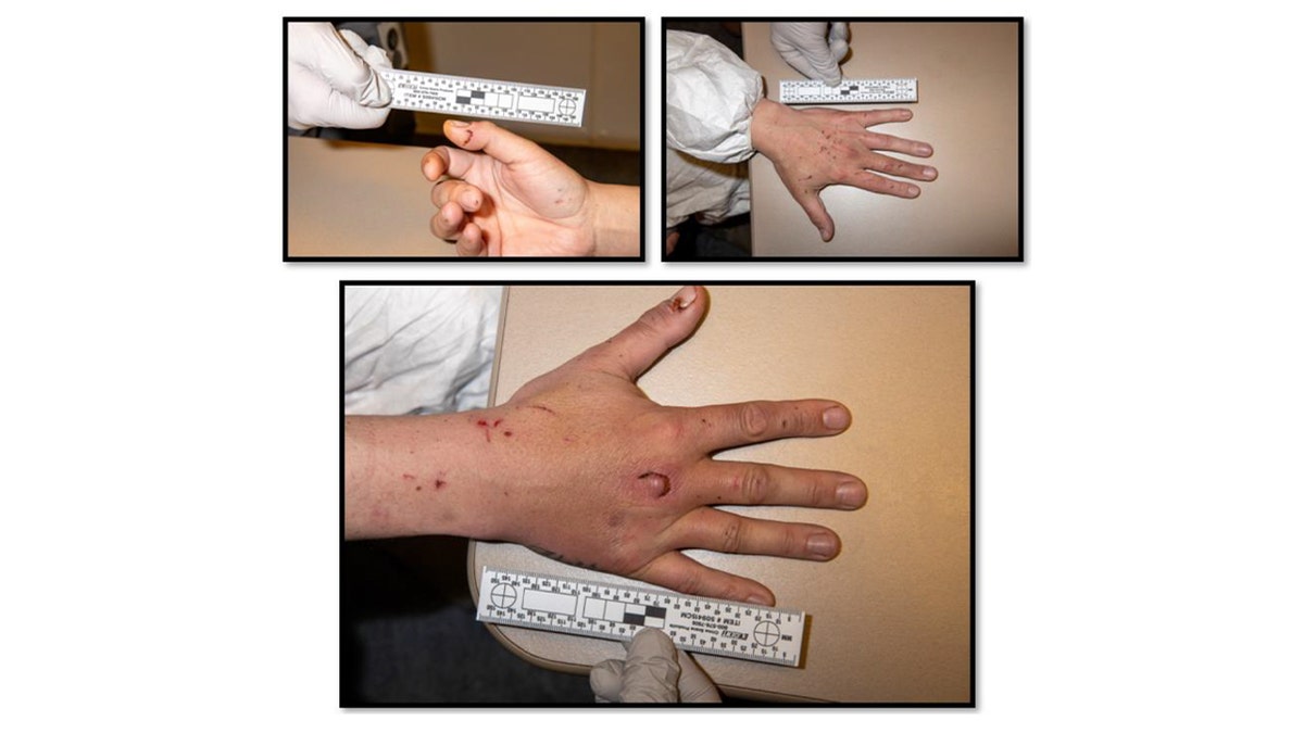 crime photos of injured hands