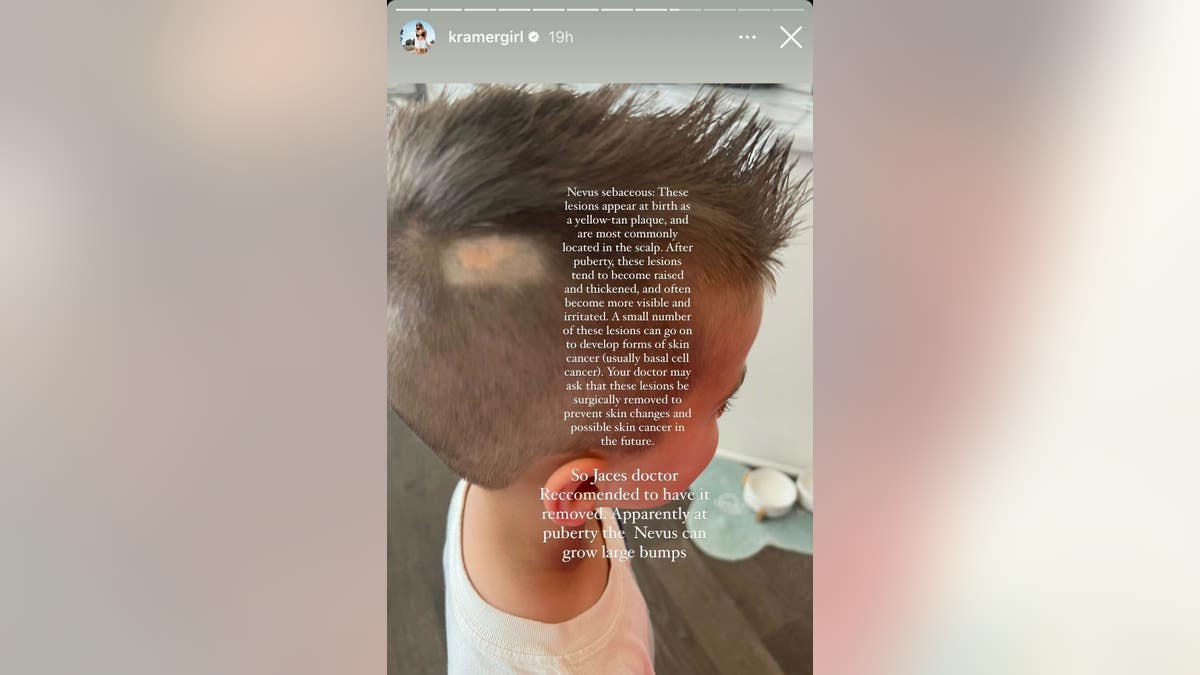 jana kramers son jaces birthmark on the side of his scalp
