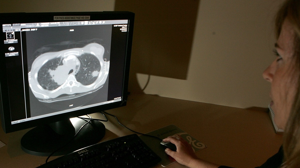 A UCSF doctor looks at a scan of a lung with a tumor