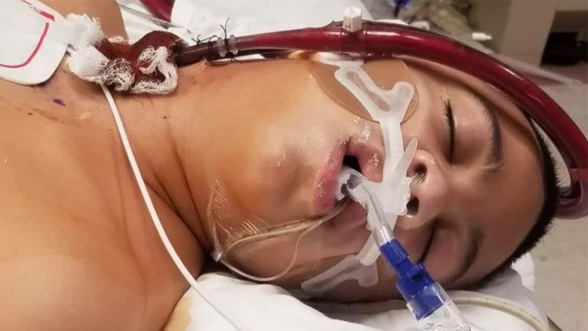 Zachary Corona, 13, with a breathing tube, his eyes closed, in a hospital bed.