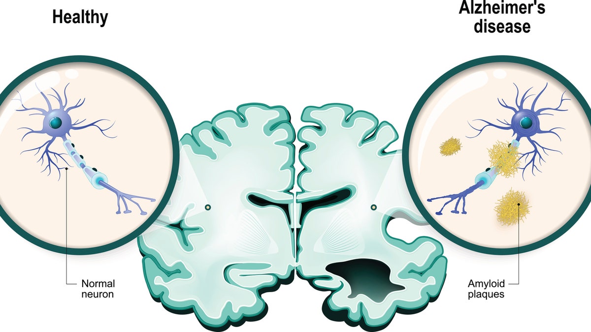 Alzheimer's brain