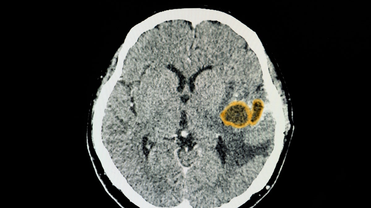 Brain abscess