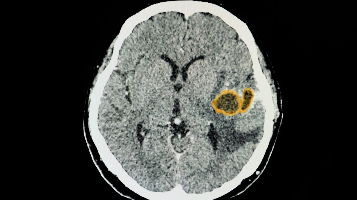 Brain abscess