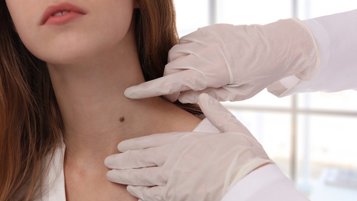 The ABCDE rule<strong> </strong>is the best way to determine if any mole or blemish is cancerous, according to a dermatologist.