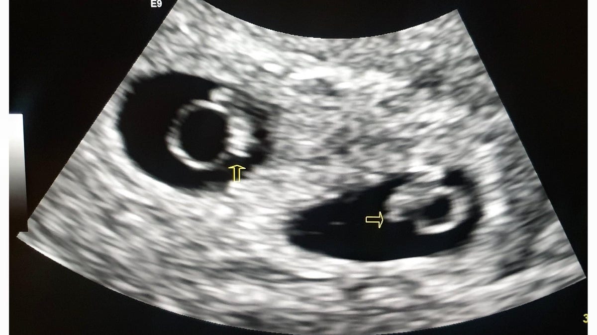 photo of twins Adial and Adrial