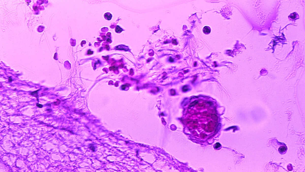 Close-up of meningitis cells