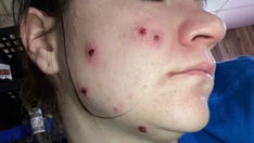 East Palestine resident experiencing lesions, stomach pain, shortness of breath since train derailment